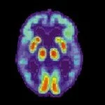 Alzheimer Brain Scan